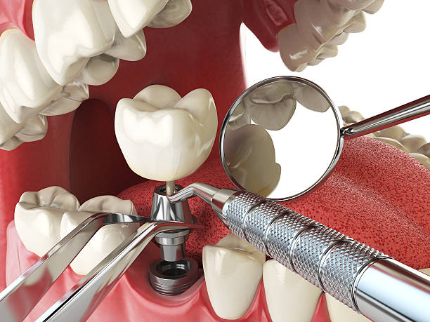 Best Emergency Wisdom Teeth Removal in Bally, PA